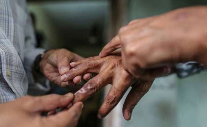 नेपालमा समुदाय स्थरमै कुष्ठरोगी बढ्यो