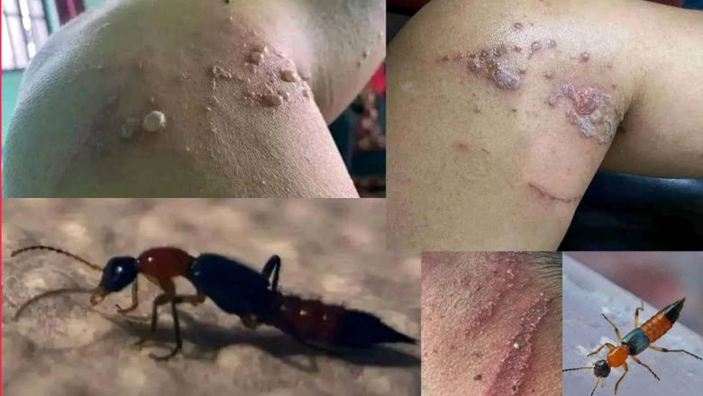 झापामा ‘नाइरोबी फ्लाइ’का सङ्क्रमित फेला