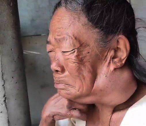 क्यान्सरले ग्रस्त बृद्धाको उपचारमा आर्थिक अभाव, साकेला टोल विकासद्धारा सहयोगको माग